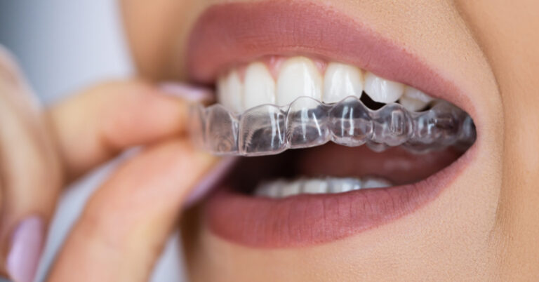 invisalign em itaquera