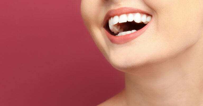 clareamento dental em itaquera