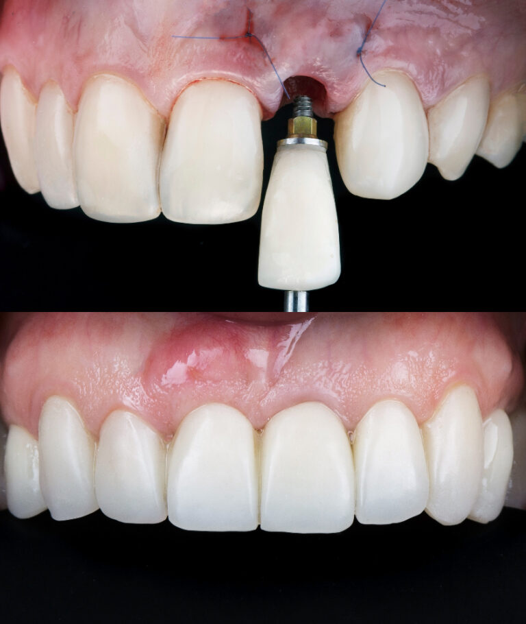 implante dentário antes e depois